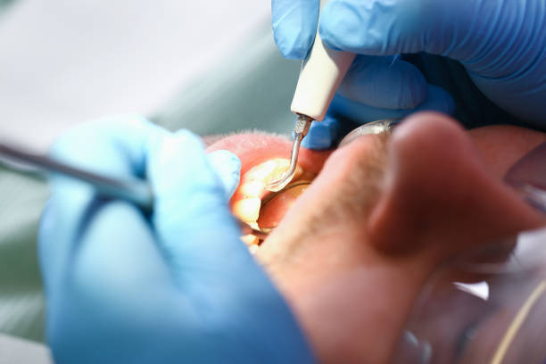 Best Urgent Care for Lost Fillings or Crowns in Davisboro, GA